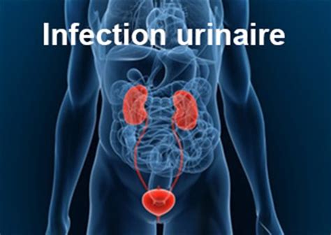 sodomie et infection urinaire|Infection urinaire: causes, symptômes, traitement et。